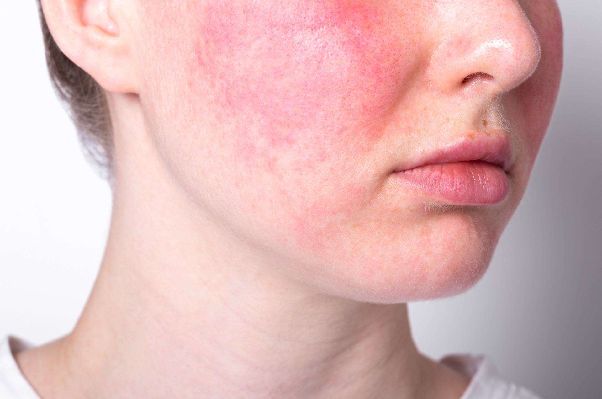 Rosacea,Couperose,Redness,Skin,,Red,Spots,On,Cheeks,,Young,Woman