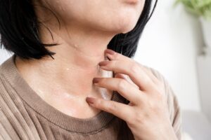 Women with urticaria on her neck