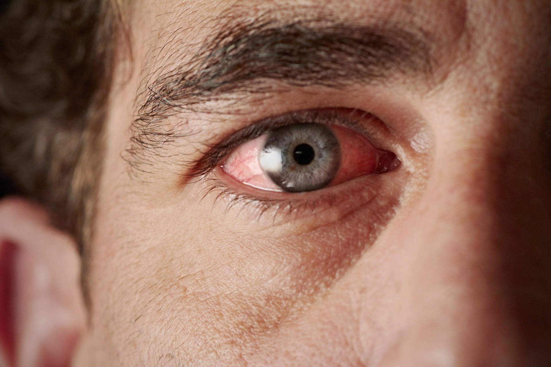 Why Does Smoking Cannabis Cause Red, Bloodshot Eyes? -